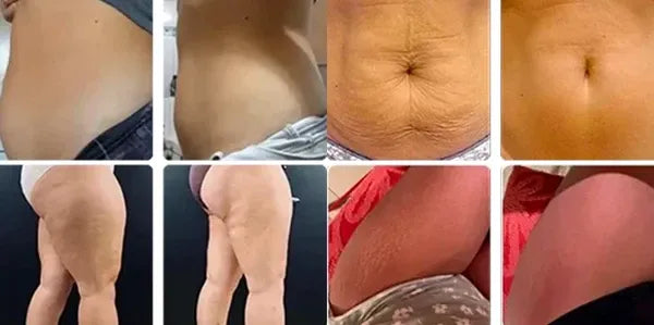 5. Actúa sobre las "zonas difíciles" donde la dieta y el ejercicio no funcionan: michelines, abdomen inferior, muslos internos.
