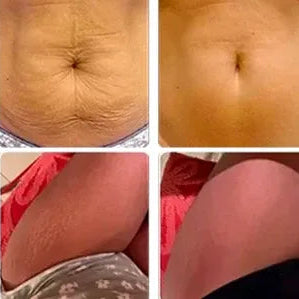 5. Actúa sobre las "zonas difíciles" donde la dieta y el ejercicio no funcionan: michelines, abdomen inferior, muslos internos.
